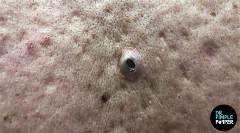 Pimple Popper&39; a 51-year-old sing mother Juliet has dozen of 25-year-old cysts squeezed on &39;Dr. . 25 year old blackhead explodes